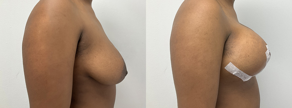 Breast Lift Before and After