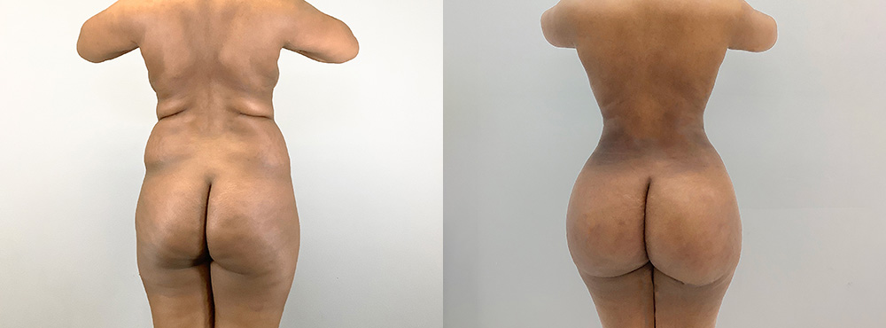 BBL Before and After