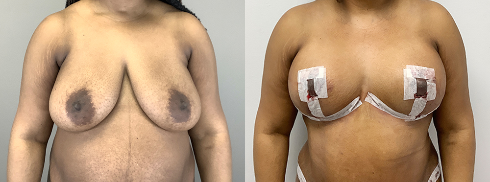 Breast Lift Before and After