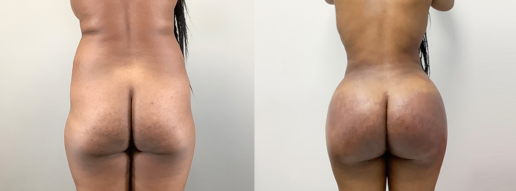 Brazilian Butt Lift Before and After