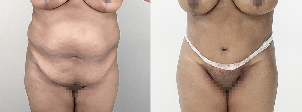 Tummy Tuck Before and After