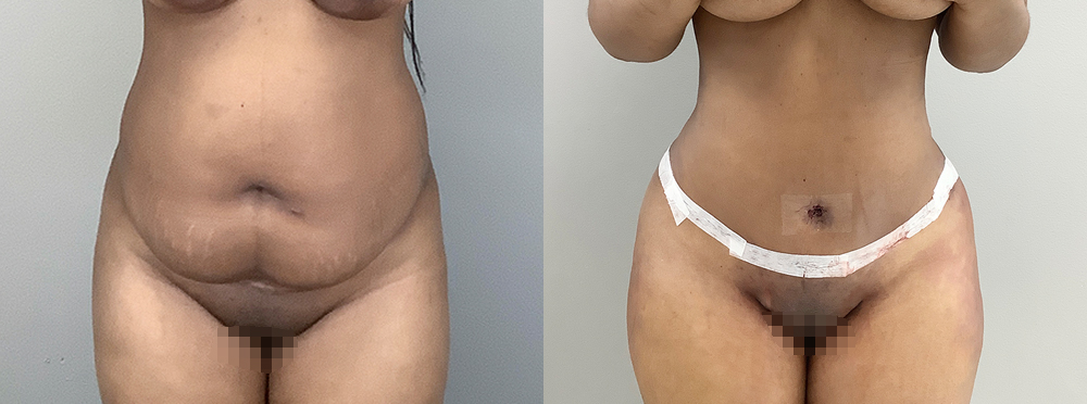 Tummy Tuck Before and After