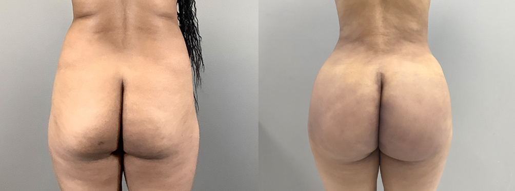 Brazilian Butt Lift Before and After