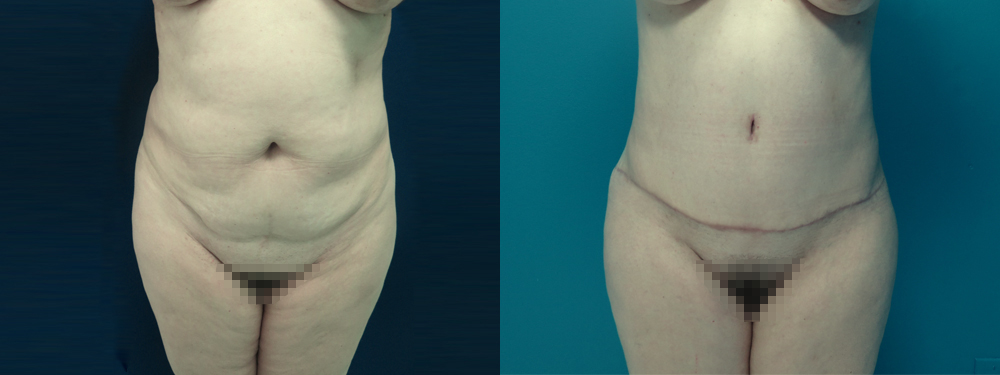 Tummy Tuck before and after