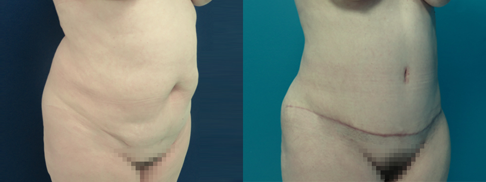 Tummy Tuck before and after