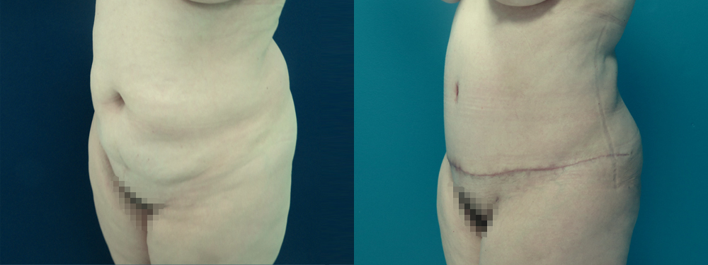 Tummy Tuck before and after