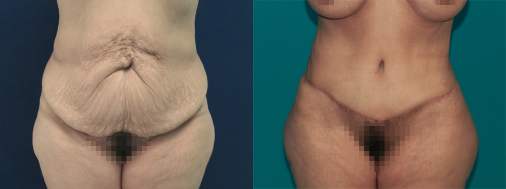 Tummy Tuck before and after