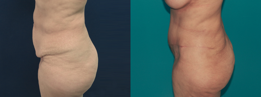Tummy Tuck before and after