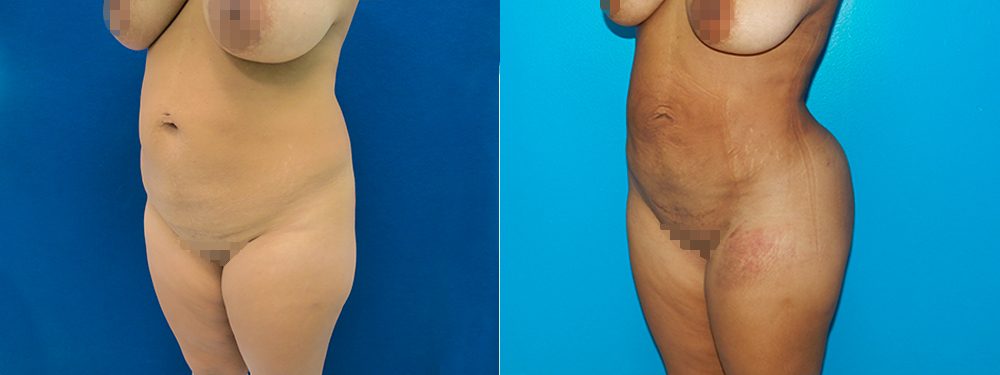 BBL before and after photos