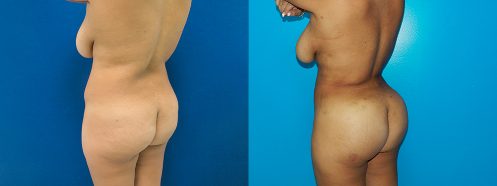 BBL before and after photos