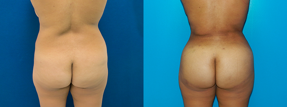 BBL before and after photos