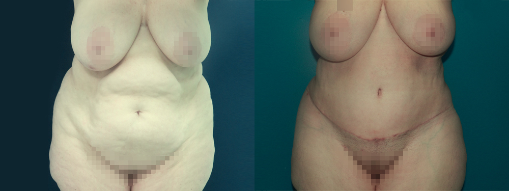 Tummy Tuck before and after