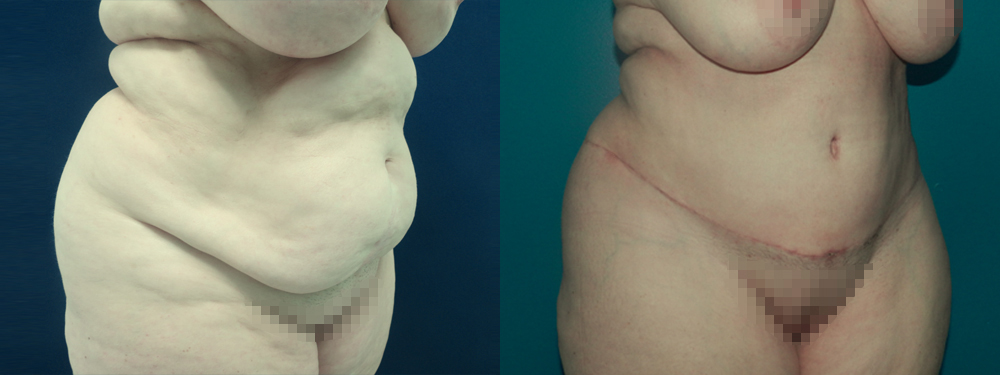 Tummy Tuck before and after