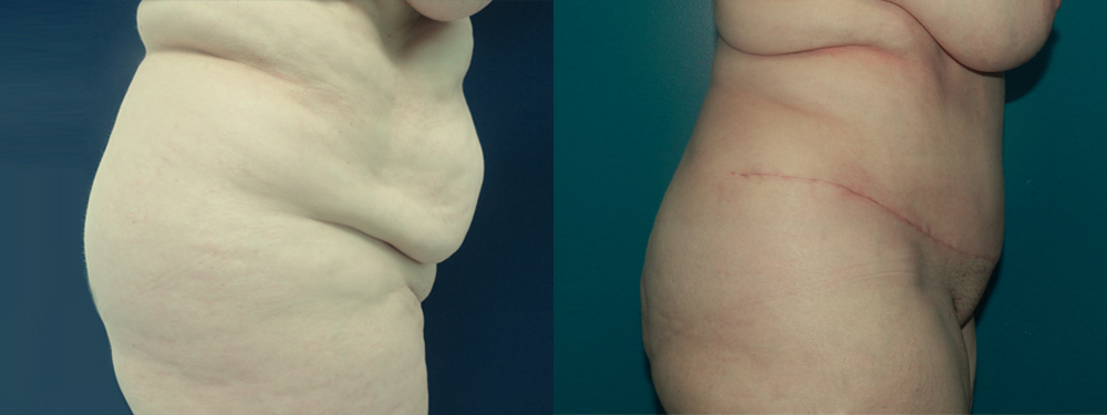 Tummy Tuck before and after