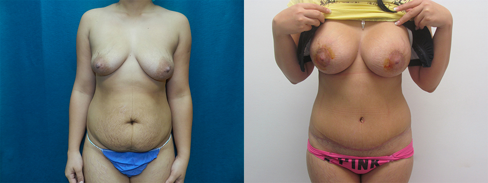 Mommy Makeover before and after