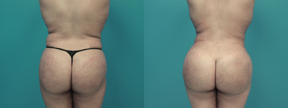 Brazilian Butt Lift before and after