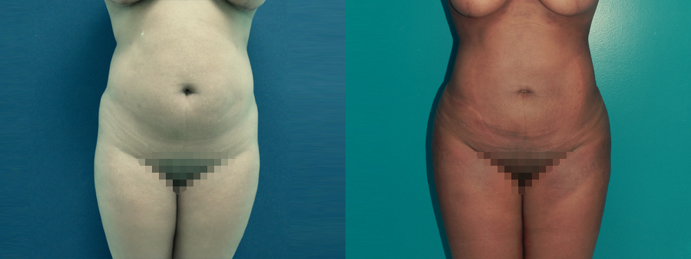 Brazilian Butt Lift before and after 