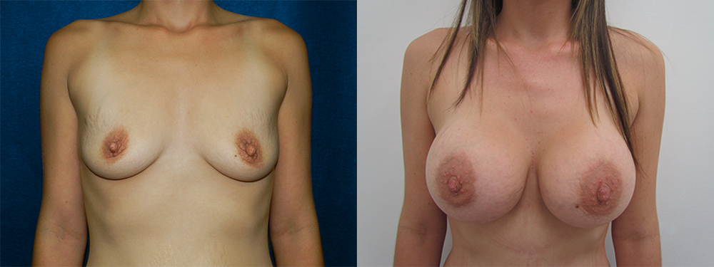 breast augmentation before and after