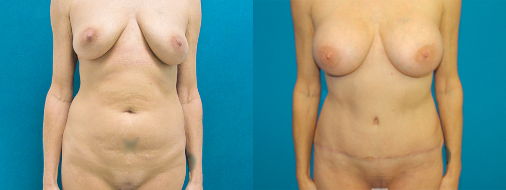 Momy Makeover before and after