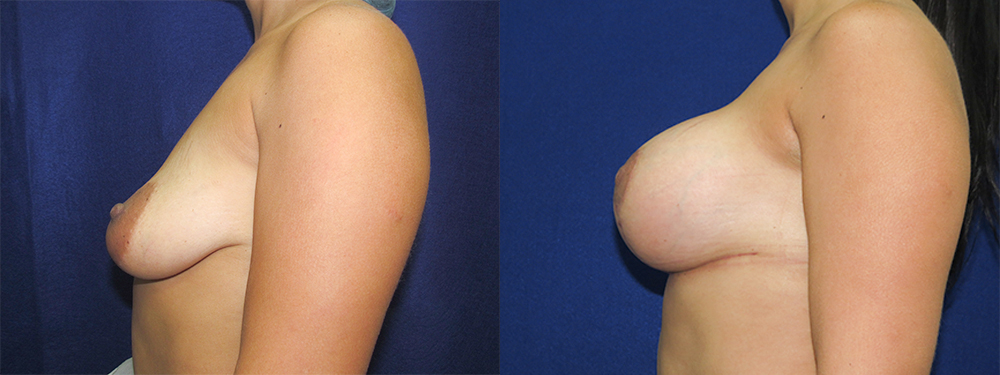 Breast Lift before and after