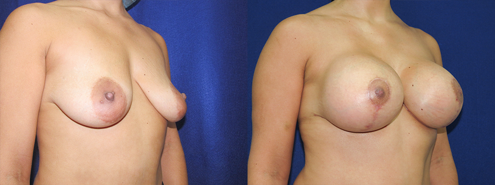 Breast Lift before and after