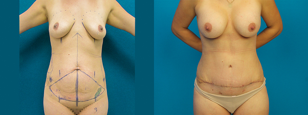 Momy Makeover before and after