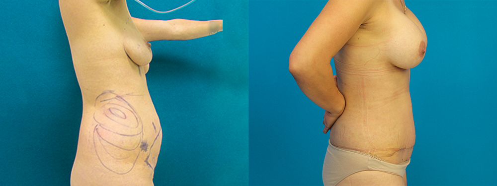 Momy Makeover before and after