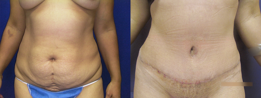 Tummy Tuck before and after