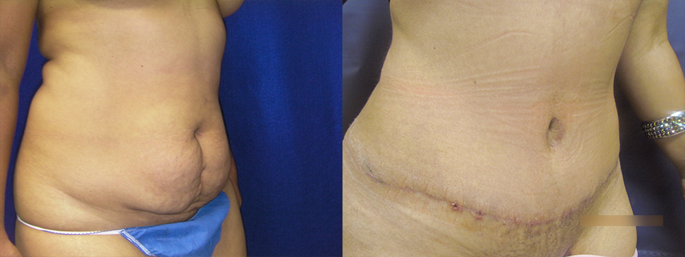 Tummy Tuck before and after