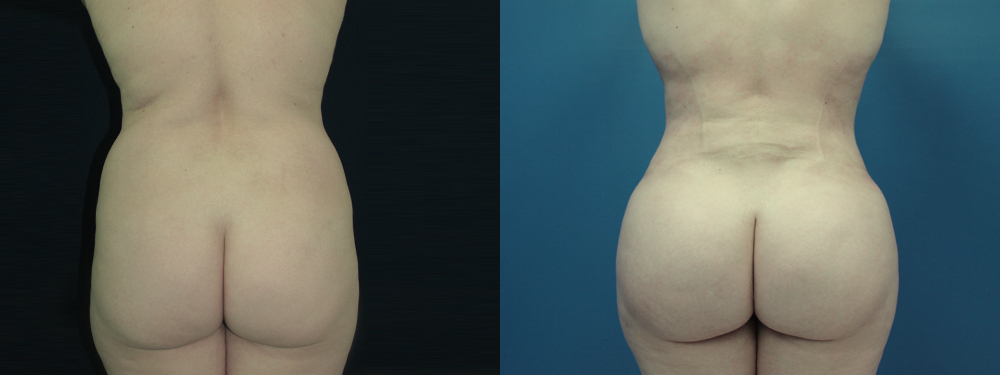 BBL before and after photos