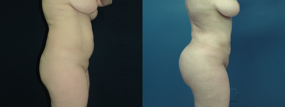 BBL before and after photos