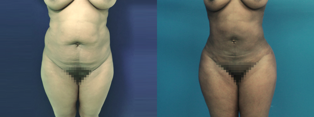 brazilian butt lift before and after