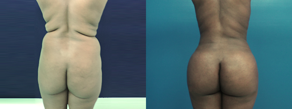 brazilian butt lift before and after