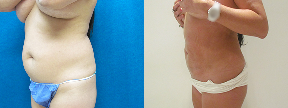 Liposuction before and after photos