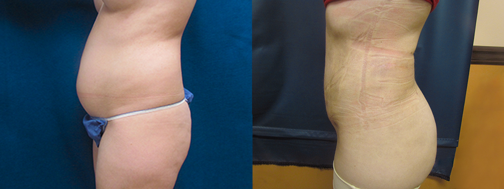 Liposuction before and after photos 