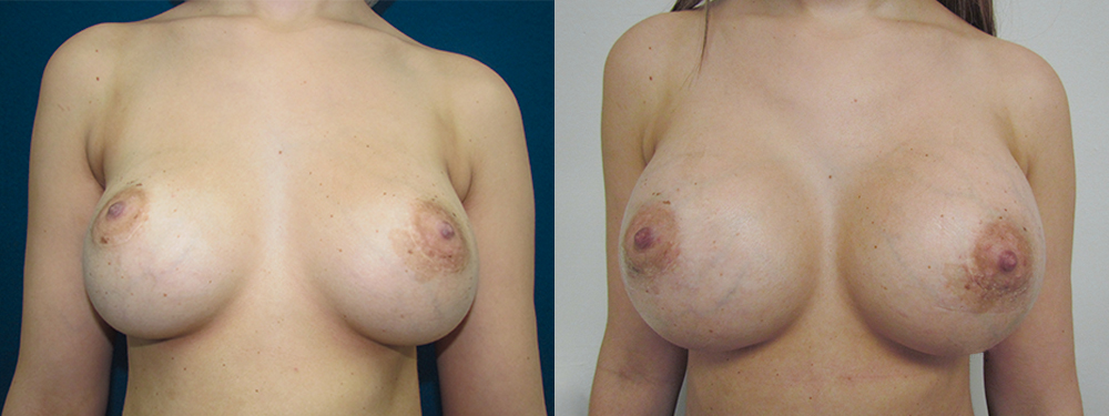 Breast Augmentation before and after 