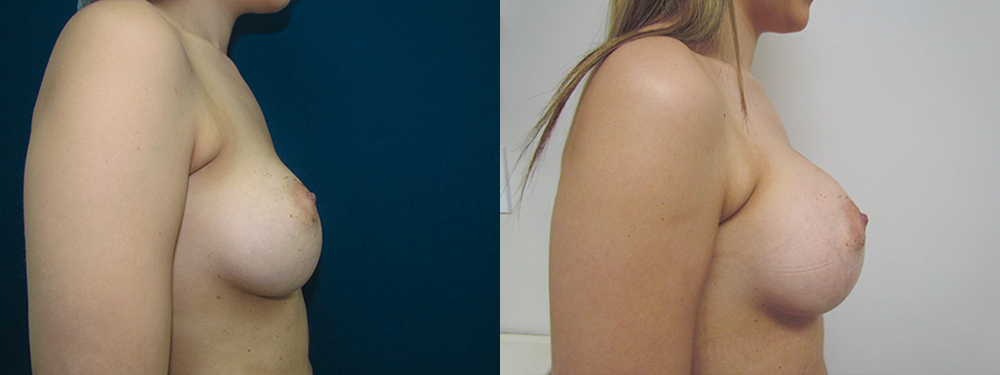Breast Augmentation before and after 