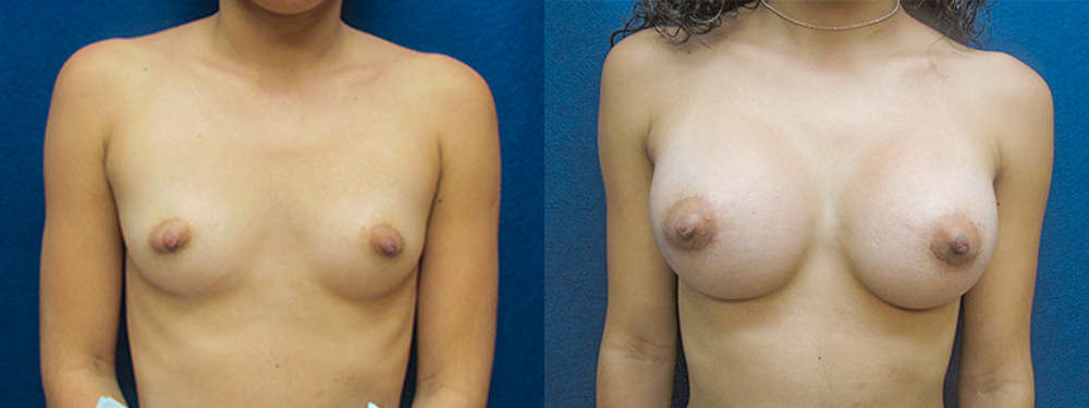 breast augmentation before and after