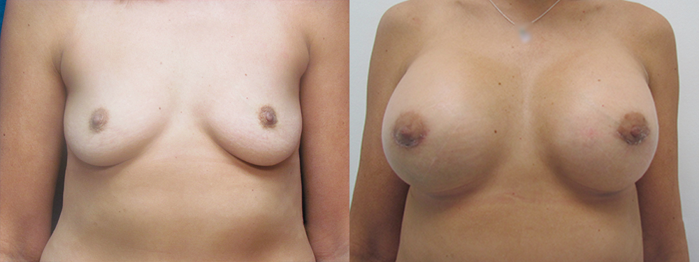 Breast augmentation before and after