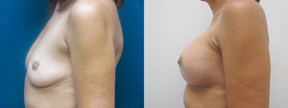 Breast augmentation before and after