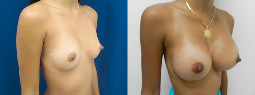 breast augmentation before and after