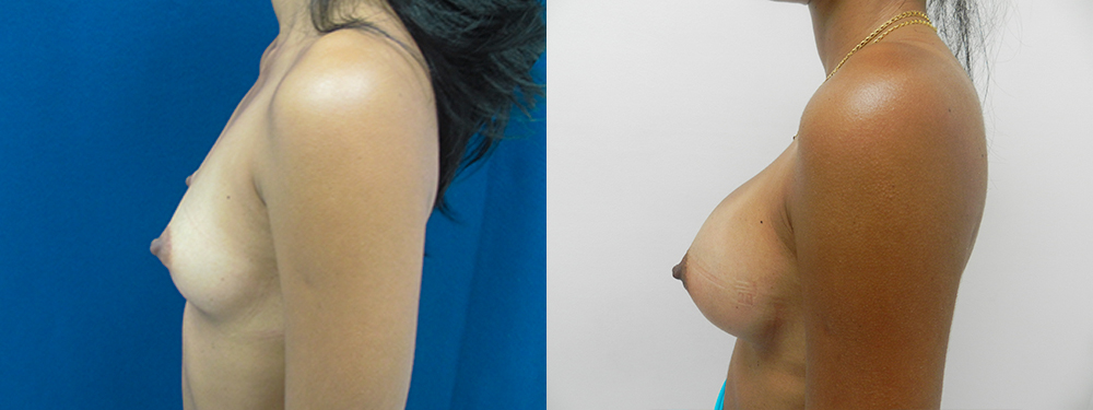 breast augmentation before and after
