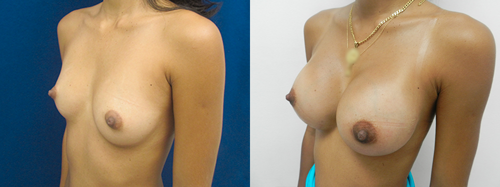 breast augmentation before and after