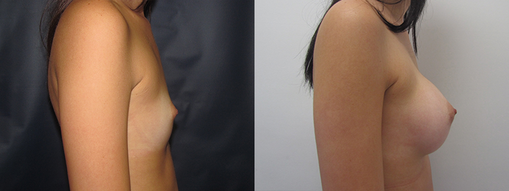 breast augmentation before and after