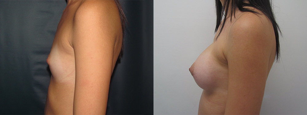 breast augmentation before and after