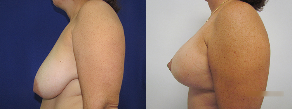 Breast Reduction before and after