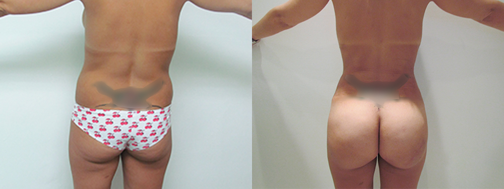 BBL before and after photos