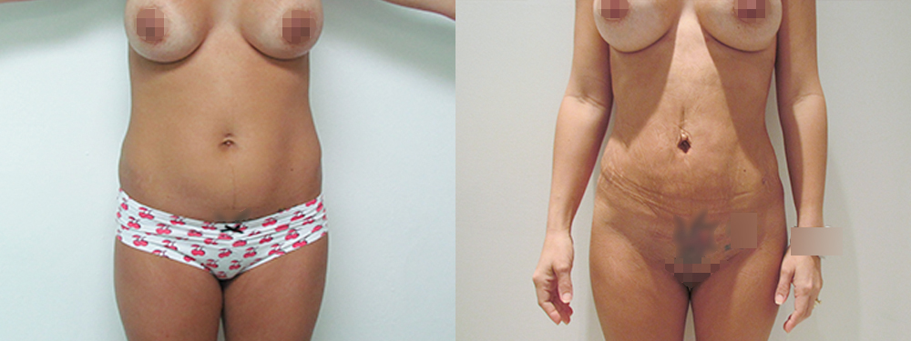 BBL before and after photos