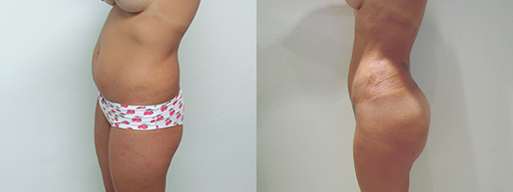 BBL before and after photos