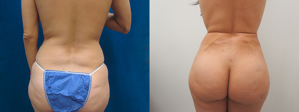 Liposuction before and after photos 